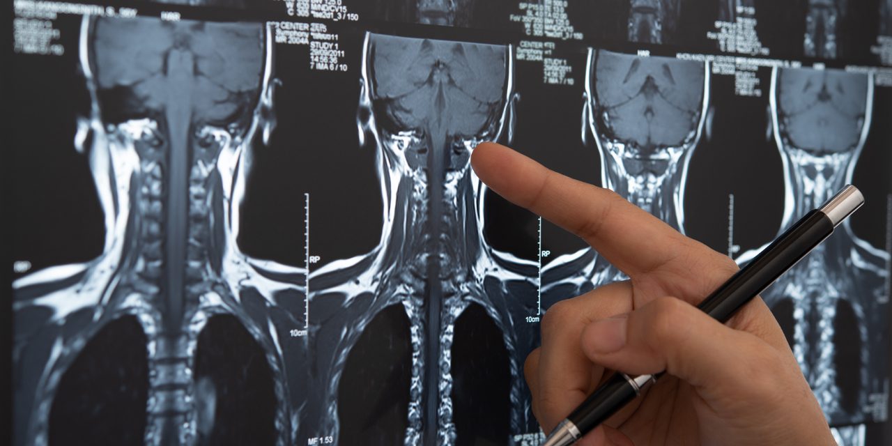 closeup of hand holding a pen pointing to spinal cord MRI result