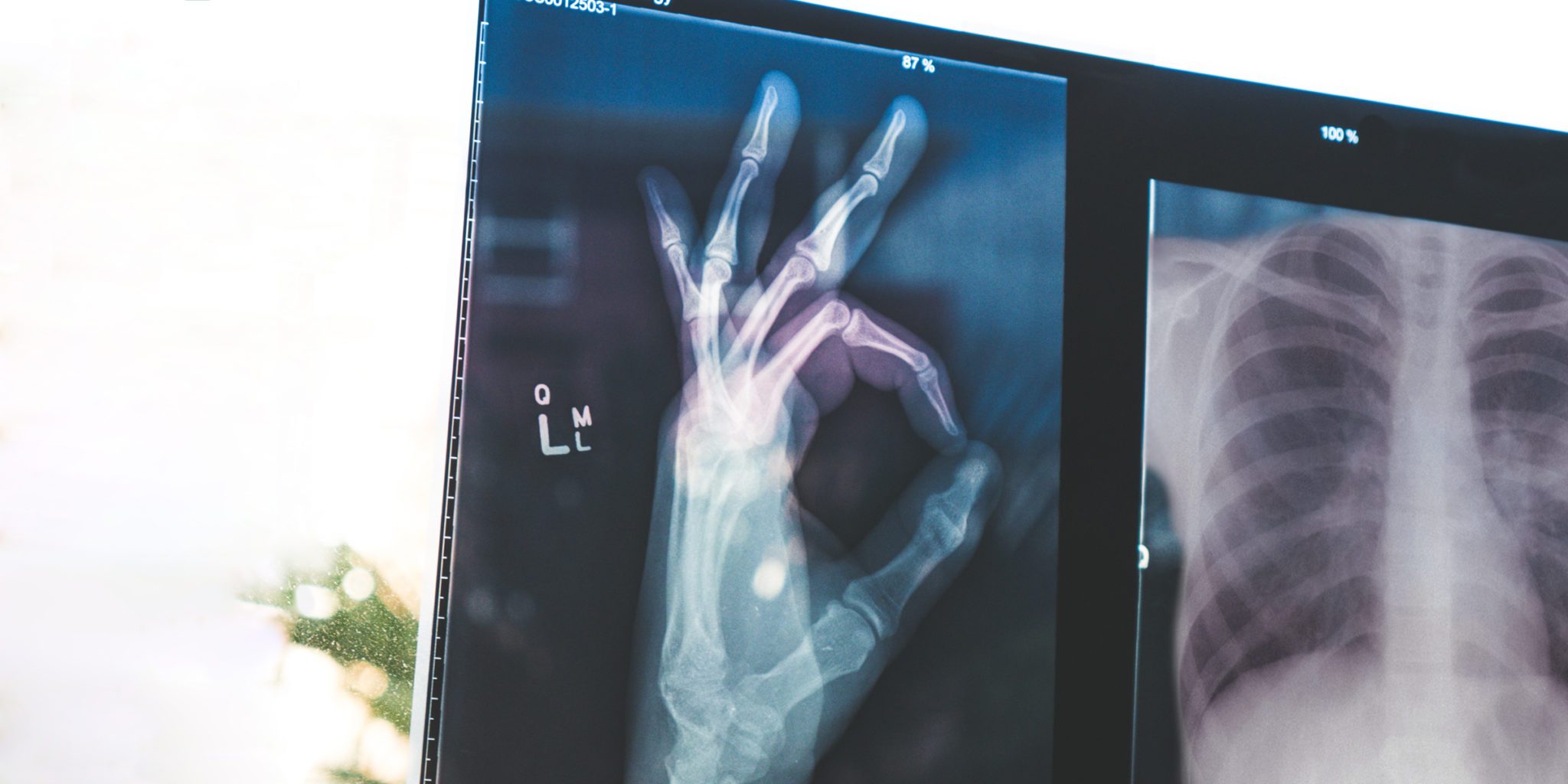 chest and okay sign hand x-rays