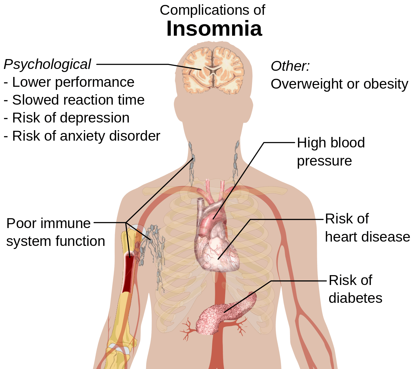 Insomnia - list of complications