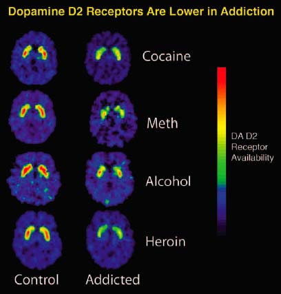 Addiction; dopamine; dopamine receptors; pleasure; reward; dopamine depletion in addiction.