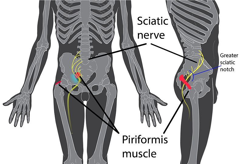 Priformis Syndrome and sciatica pain
