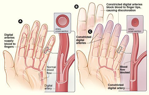 Raynaud's; Raynaud Syndrome; primary Raynaud's; secondary Raynaud's; blood flow; arteries; Raynaud's phenomenon.
