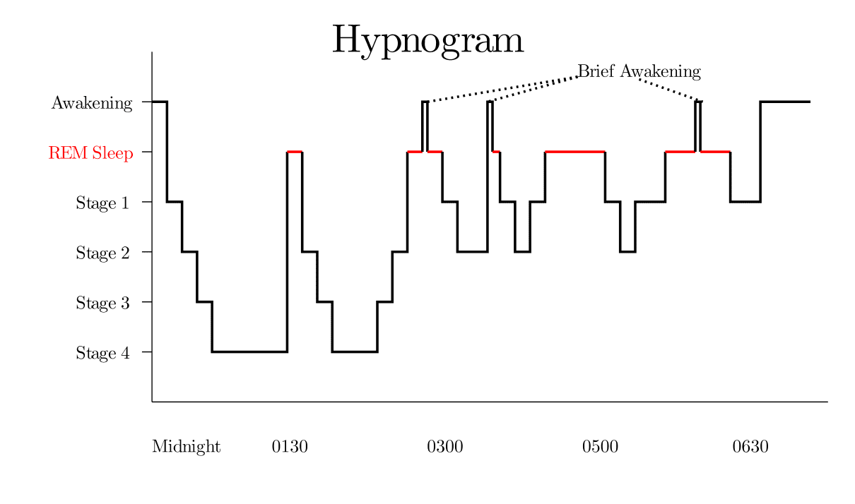 sleep hypnogram; insomnia; sleep graph.