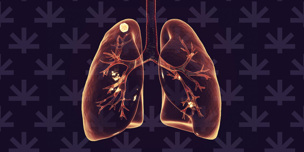 graphical image of lungs with tuberculosis