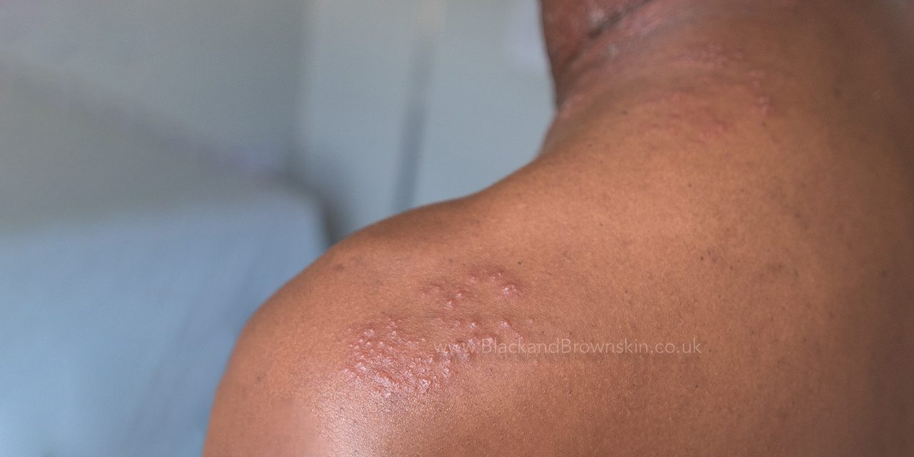 part of the back of a person with shingles