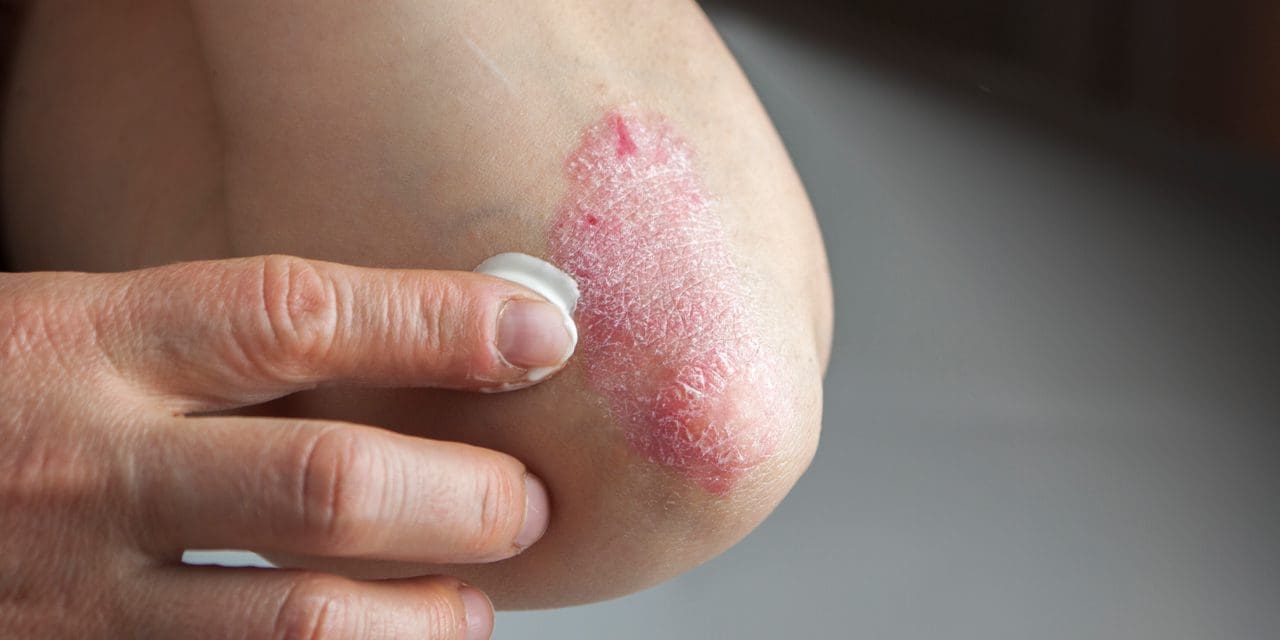 How Does Smoking Affect Psoriasis?